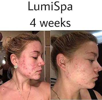 lumispa for acne
