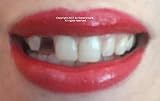 Temporary tooth repair kit temp dental fix missing for 10 teeth! Now with DVD!