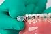 OrthoDots CLEAR (24 Count) - Moisture Activated, Silicone Dental Wax Alternative for Pain Caused by Braces. OrthoDots Stick Better & Stay on Longer than Orthodontic Wax (48 1.0)