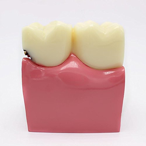 6 Times Caries Contrast Oral Model, Teeth Teaching Models for Research, Use for Patient Communication