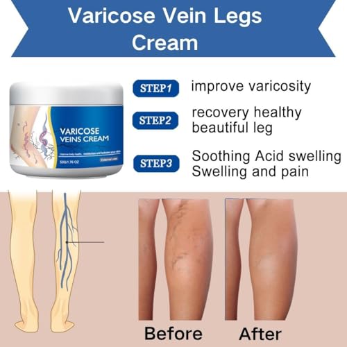 LBOYLOVE® 2 PCS Varicose Veins Cream for Legs, Spider Varicose Veins ReliefCream, SkinCream for Legs, Cream for VaricoseVeins