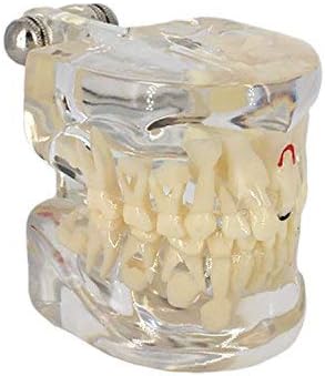YOUYA Professional Kids Permanent Teeth Alternating Pathology Caries Model Transparent Typodont Study Dental Teaching Model
