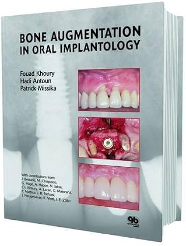Download Bone Augmentation in Oral Implantology PDF