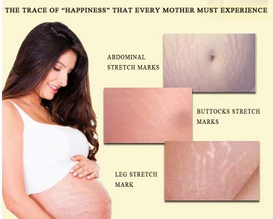 oedo rose remove stretch marks