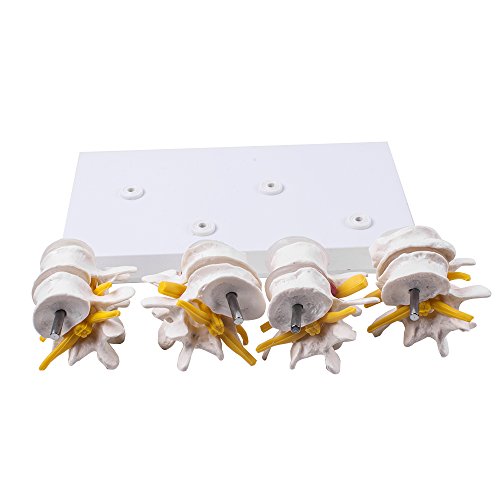 image for Zorvo 4-Part Anatomical Human Lumbar Vertebrae Degenerative Lumbar dis