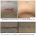 Scar Cream Silicone Aloe Vitamin C 0.9 fl oz Hypoallergenic Dark Spot Therapy Scar Treatment