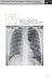 Chest X-Ray Made Easy