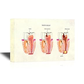 BRAND_NAMETooth Decay Diagram Home Art