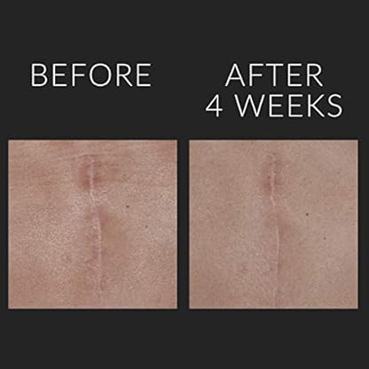 scar diminishing somerville