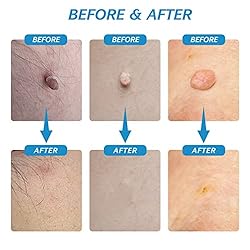 Skin Tag Remover, Upgraded 2 in 1 Skin Tag Removal