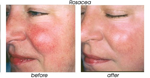 70 Glycolic Acid Skin Peel with Free Fan Brush