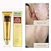 Scar and Acne Spots Mark Removal Gel Cream Face Care Acne Treatment Whitening Moisturizing Facial Cream 30ml