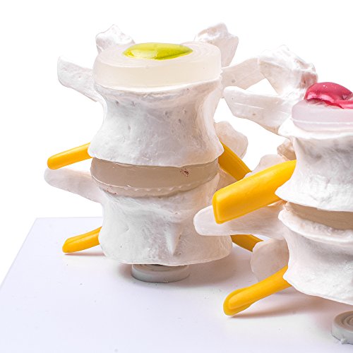 image for Zorvo 4-Part Anatomical Human Lumbar Vertebrae Degenerative Lumbar dis