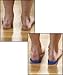 Unisex Corrective Posture Gel Heel Cups Fix Pronation, Supination and Heel Spurs Foot Support