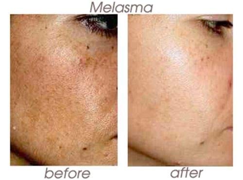 70% Glycolic Acid Skin Peel with Free Fan Brush- Unbuffered Professional Grade
