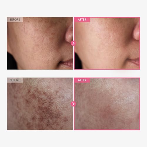 LBOYLOVE® Arbutin 7% + Tranexamic Acid 4% Cream, Skin Freckle Cream with 70,000ppm Arbutin, 40,000ppm TXA, Niacinamide & Glutathione for Dark Spots, Freckles, Blemishes and Pigmentation