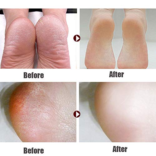 Foot File Pedicure Rasp Callus Remover,Double-Sided Colossal Foot Rasp Foot File and Callus Remover to Remove Hard Skin (Pack of 6)