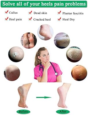 silicone heel cups for cracked heels