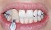 Impressive Smile Teeth Whitening Pens 2 PACK with Professional Strength Gel – 60 Days Supply