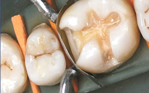 50 of Dental Sectional Contoured Matrices Matrix + 200 Wooden Wedges - Thumbnail 2