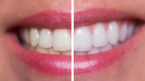 Premium Teeth Whitening Kit by GOGO White Teeth Whitening, Dental Grade Whitening Gel Made in USA in Large 10cc Syringe, Custom Teeth Bleaching Trays, Powerful Blue Light, Best Tooth Whitener