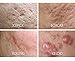 Acne Scars Removal SILICON & COLLAGEN Polisher Crystals Fades Deep Pitted, Indented, Keloid & Atrophic Type. 4 oz