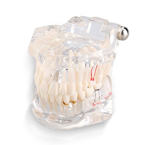 Yosoo Transparent Adult Pathologies Dental Dentist Implant Demonstration Periodontal Disease Assort Teeth Gums Tooth Care Teaching Study Standard Typodont Model - Removable (1 pcs)