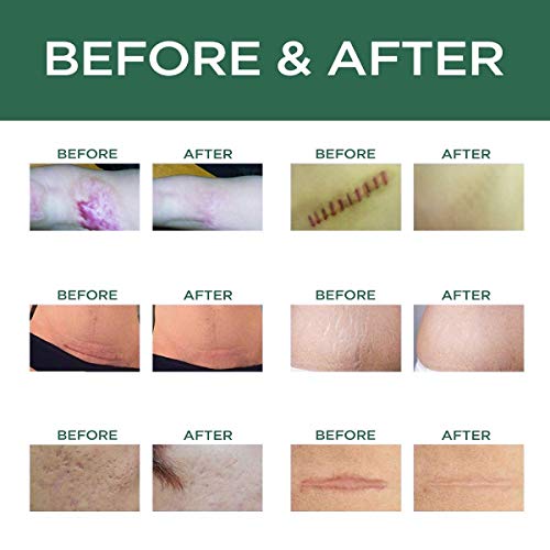 Scar Removal Cream Advanced Treatment for Old & New Scars from Cuts Stretch Marks, C-Sections & Surgeries With Natural Herbal Extracts Formula