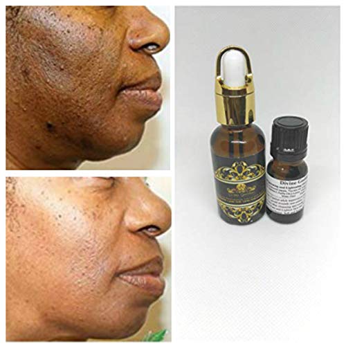 (1 oz / 30 ml) Lactic Acid Peel 88% -Chemical Peel-Unbuffered-Alpha Hydroxy (AHA) For Acne, Oily Skin, Wrinkles, Blackheads, Large Pores,Skin Lightening & Free After Peel Lightening & Brightening Oil (1 oz / 30 ml) Lactic Acid Peel 88% -Chemical Peel-Unbuffered-Alpha Hydroxy (AHA) For Acne, Oily Skin, Wrinkles, Blackheads, Large Pores,Skin Lightening & Free After Peel Lightening & Brightening Oil