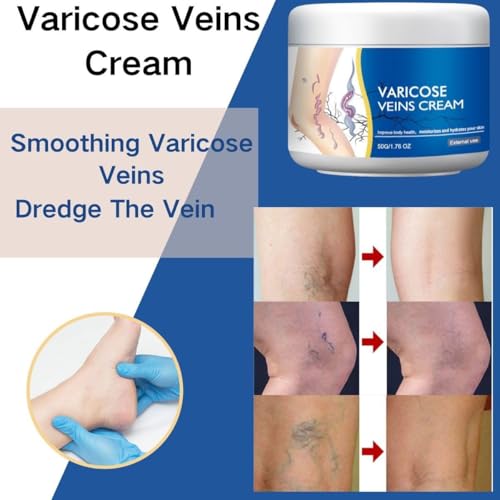 LBOYLOVE® 2 PCS Varicose Veins Cream for Legs, Spider Varicose Veins ReliefCream, SkinCream for Legs, Cream for VaricoseVeins