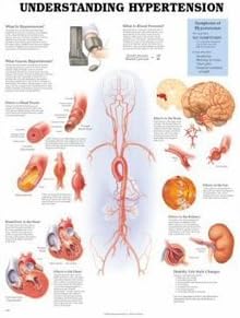 AWW 9781587794223 Understanding Hypertension 20 in. x 26 in. 1.5