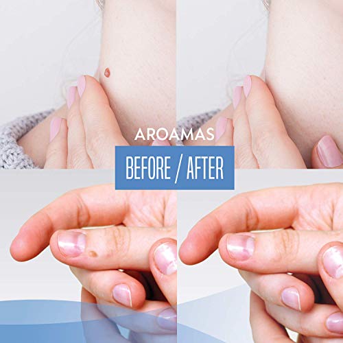 Aroamas All-Natural Wart Remover Treatment, Maximum Strength for Common Warts and Infections, Also Promotes The Healing of Calluses and Corns