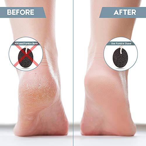 Foot Pumice Stone, Foot Scrubber Callus Remover, Exfoliation to Remove Dead Skin for Foot, Heel, Toes, Dry Dead Skin Scrubber Corn Remover Natural Foot File Massage Spa