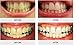 truewhite Advanced Plus Teeth Whitening System for 2 Person - Made in USA - No Sensitivity - Easy to Use Perfect Professional Teeth Whitening Kit - FDA Registered