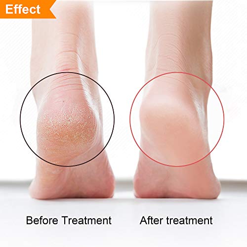 MASWATER Callus Remover/Foot Rasp/Foot File/Foot Scrubber with Double Side Scrubs& 3pcs Nutritions Foot Mask for Your Foot Care Pedicure at Home on Feet Without Pain- Foot MASK