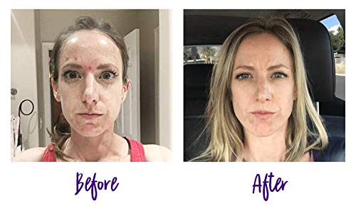 5 Treatment+Probiotics+Multi+Fruit+Salicylic+Blemishes