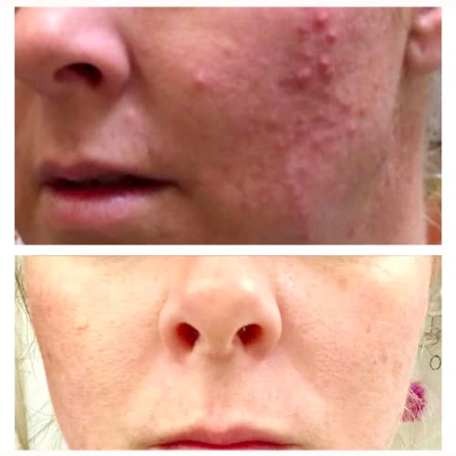 Mandelic Acid Peel 40 Intense Chemical Peel for Face Mandelic Acid