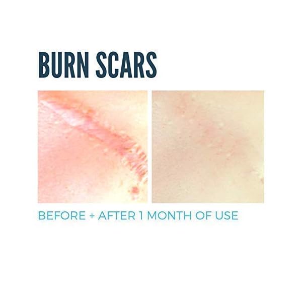 MD Performance Ultimate Scar Formula Advanced Silicone Scar Gel for