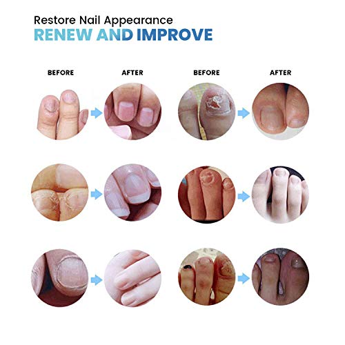 Toe Repair Fluid - Nail & Toenail Care Fungus Treatment - 2 Pcs