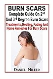 Image de Burn Scars : Complete Guide On 2nd And 3rd Degree Burn Scars: Treatments, Healing, Fading And Home Remedies For Burn Scars