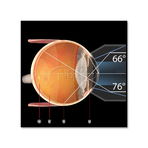 Volk G-3 Gonio Lens - Contact, Coating & Size Options (Volk G-3 Gonio Lens - Flanged Contact)