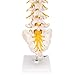 3B Scientific A76/5 Lumbar Spinal Column with Dorso-Lateral Prolapsed Intervertebral Disc, 13.4