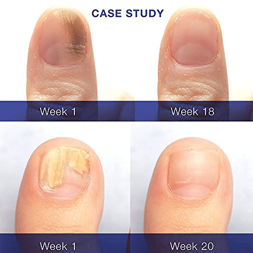 Dr. Luke Nail Fungus Treatment Extra Strength, Toenail Fungus Treatment, Fungus Nail Treatment