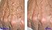 TCA 50% Tattoo removal, Skin tags, Warts, Age Spots, Freckles (1/2 oz) (15ml) by RePare Skincare