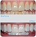 Professional Dental Strength 35% FAST ACTING Teeth Whitening Gel. Includes 4 XL 10cc Syringes of Whitening Gel! Up TO 120 Applications! Made in USA!