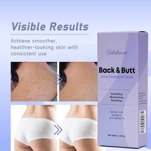 Tobcharm Butt Acne Clearing Treatment, Maximum Strength Body Cream for Back, Buttocks, Thighs & Chest Acne Removal, Skin Clarifying Lotion for Men & Women, Foam Cleaner for Bacne