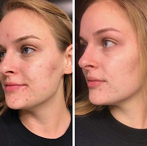 7X FASTER Acne Treatment Cream ALL Skin Types Scar Removal Spots Blackheads Cystic Acne Bacne Pimples SECRET TEA TREE OIL Formula Results In Just Days WITHOUT Drying Your Skin - Keeva Organic (2oz) - Thumbnail 6