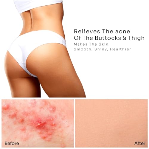 Anti-Acne Thigh & Buttocks Treatment - Clears Away Acne, Pimples, and Ingrown Hairs for the Buttocks and Thigh Area. Prevents Future Breakouts. 6.09 oz
