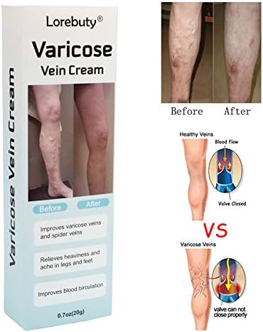 Varicose Veins Cream,Varicose Vein&Soothing Leg Cream,PhlebitisVasculitis Angiitis Inflammation Blood Vessel Spider Vein Treatment,StrengthenCapillaryHealth,Improve Blood Circulation andVaricoseVeins