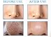 USA PURADIANT Blackhead Vacuum I Pore Vacuum I Suction Removal | Extractor Cleanser | Electric Facial System | USB - Plug Rechargeable